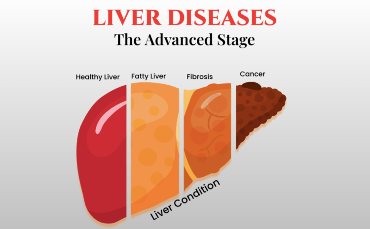 Diagram depicting the different stages of liver disease