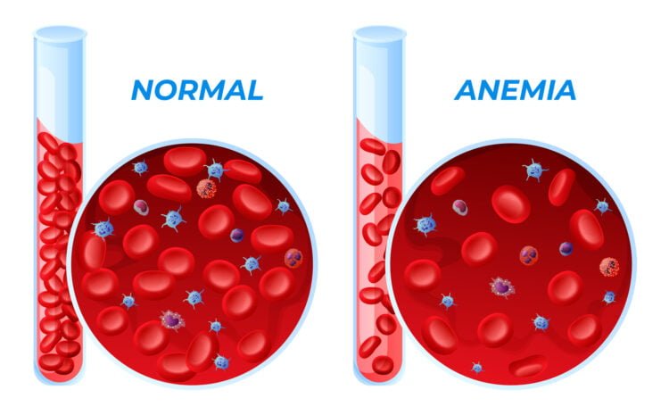 Drawing of Test tubes showing healthy blood sample and anemic blood sample