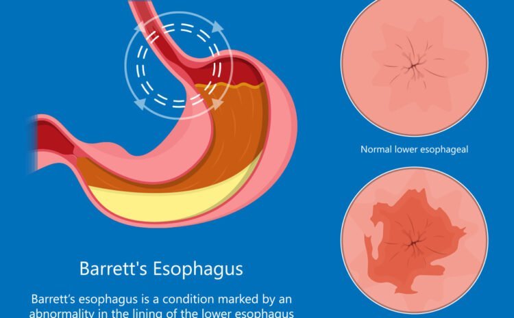 drawing of stomach and esophagus