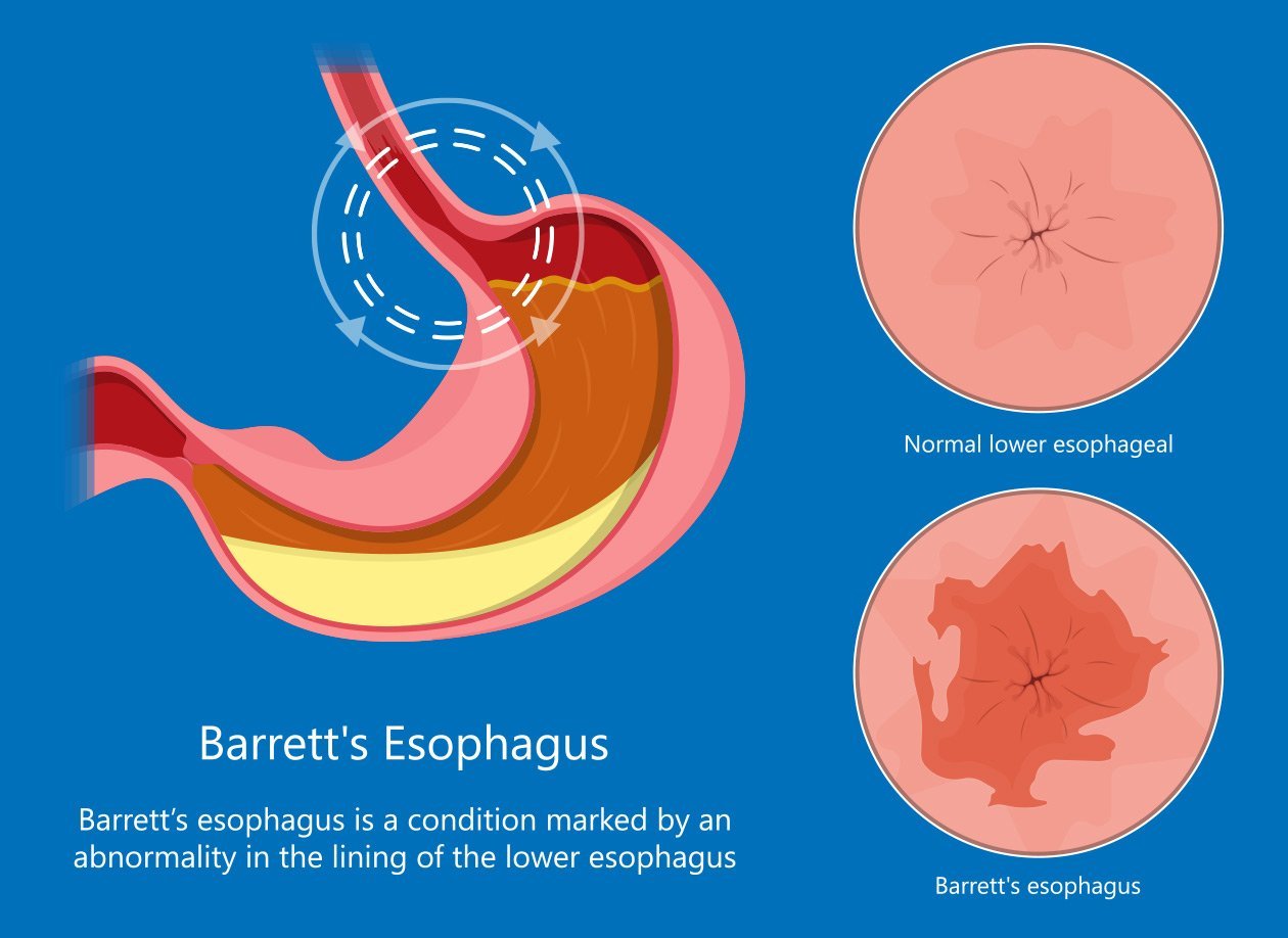 Barrett’s Esophagus- Causes, Diagnosis, Treatment and Prevention