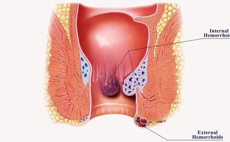 Biological diagram of Hemorrhoids/ Piles