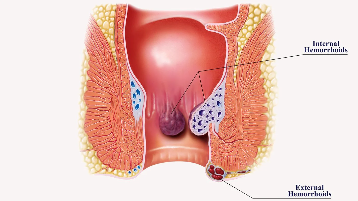 does tirzepatide cause hemorrhoids Haemorrhoids- Causes, Diagnosis, Treatment and Prevention