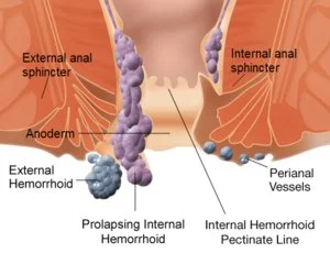 Best Piles Surgery Treatment doctor in Ahmedabad