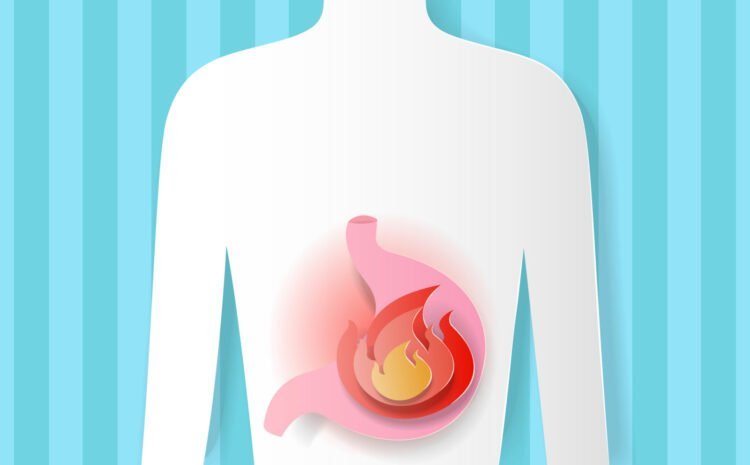 Acidity: Causes, Diagnosis, Treatment and Prevention