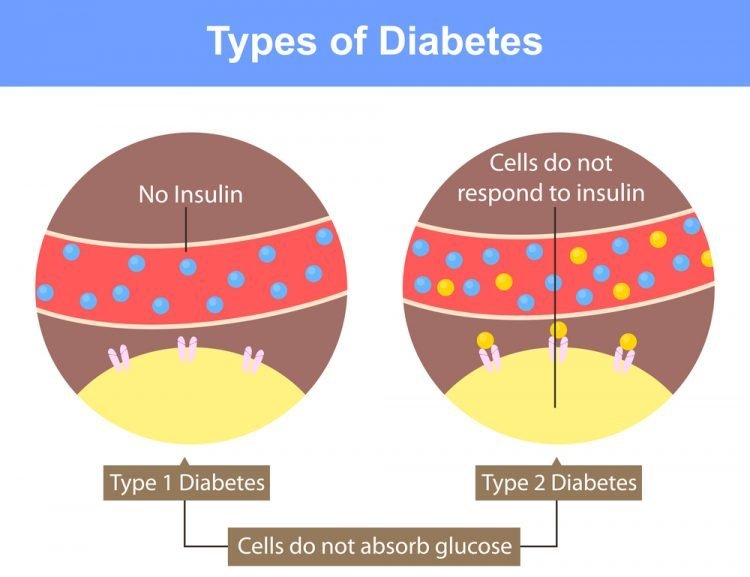 DIABETES TYPE 1 AND TYPE 2