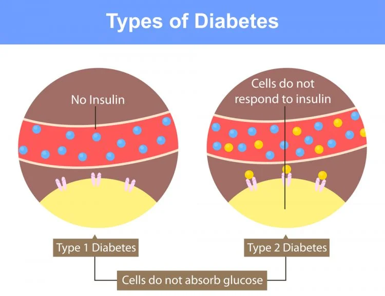 DIABETES TYPE 1 AND TYPE 2