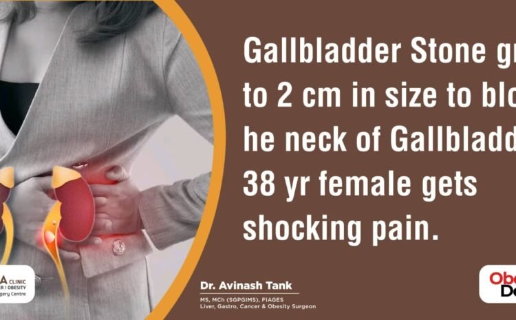 Gallbladder Stone grows to 2 cm in size to block t he neck of Gallbladder, 38 yr female gets shocking pain.