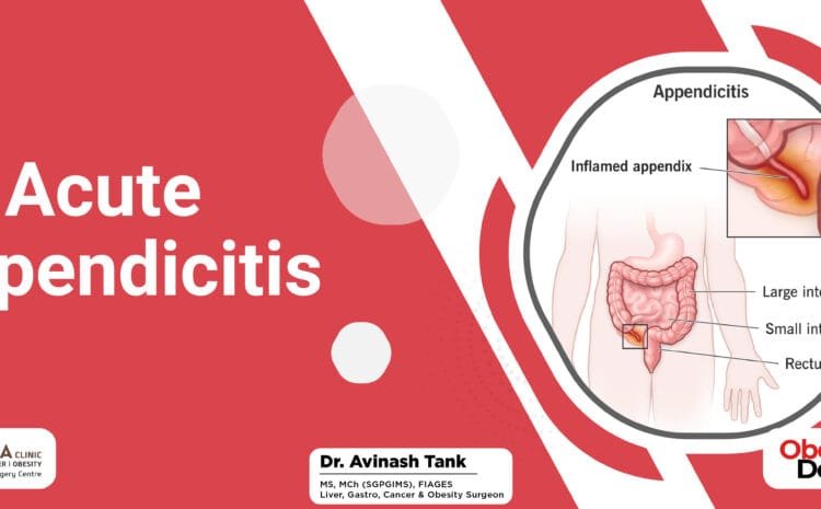 Acute Appendicitis