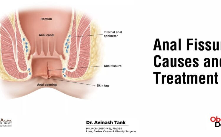 Anal Fissure: Causes and Treatment