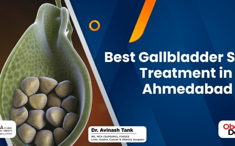 Best Gallbladder Stone Treatment in Ahmedabad