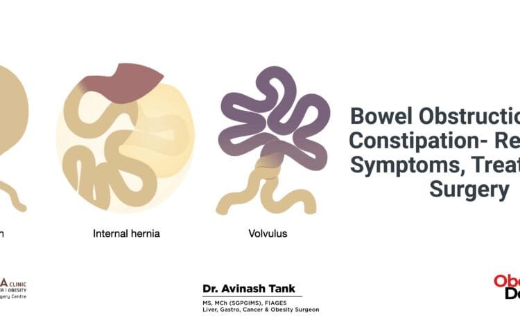 Bowel Obstruction and Constipation- Relation, Symptoms, Treatment, Surgery