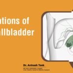 Complications of Small Gallbladder Stone