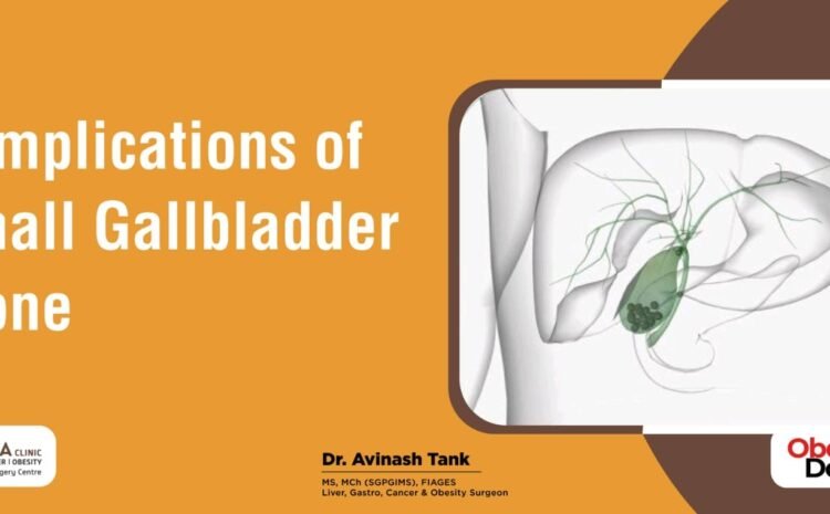 Complications of Small Gallbladder Stone