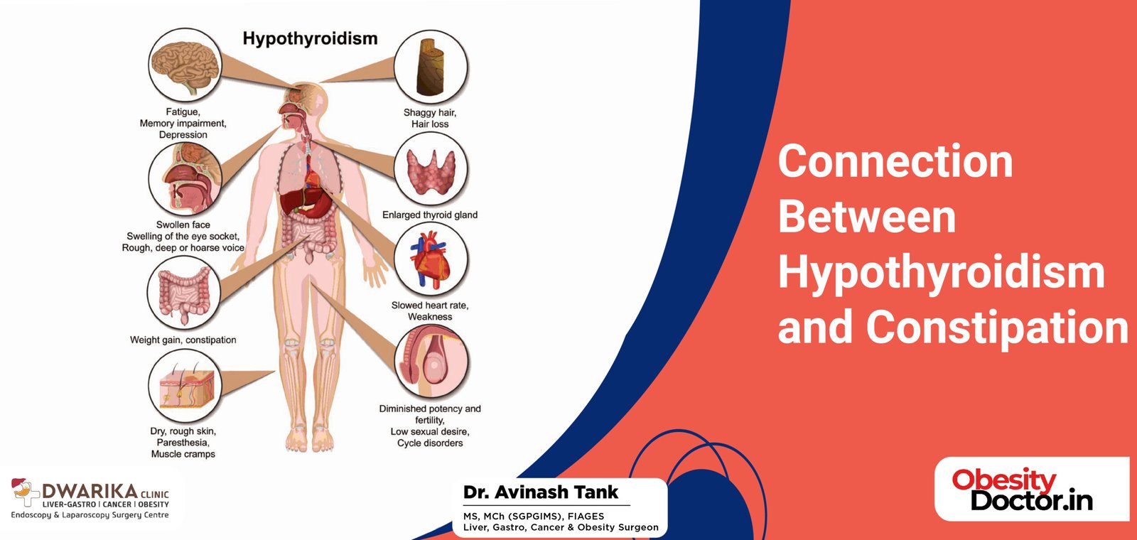Connection Between Hypothyroidism and Constipation
