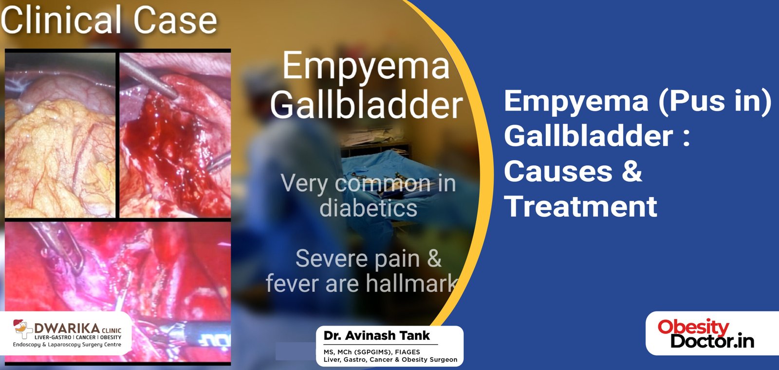 Empyema (Pus in) Gallbladder : Causes & Treatment
