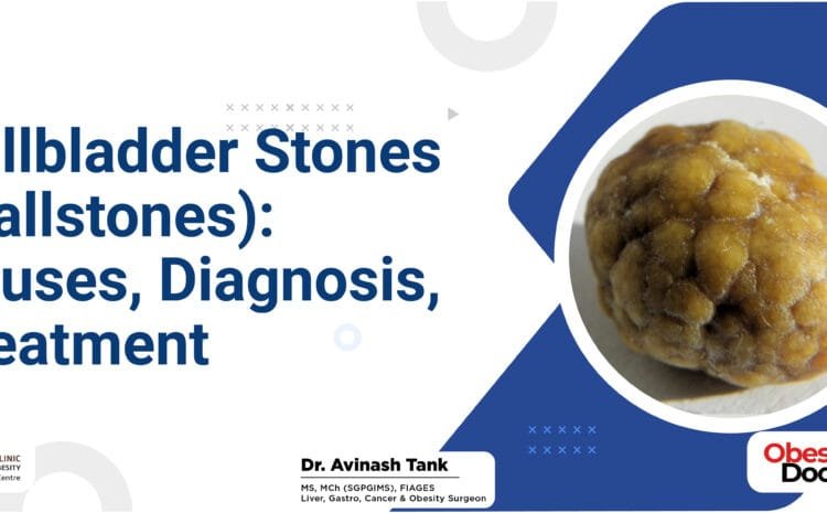 Gallbladder Stones (Gallstones): Causes, Diagnosis, Treatment