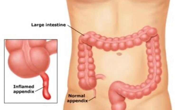 Appendix Treatment in Bopal