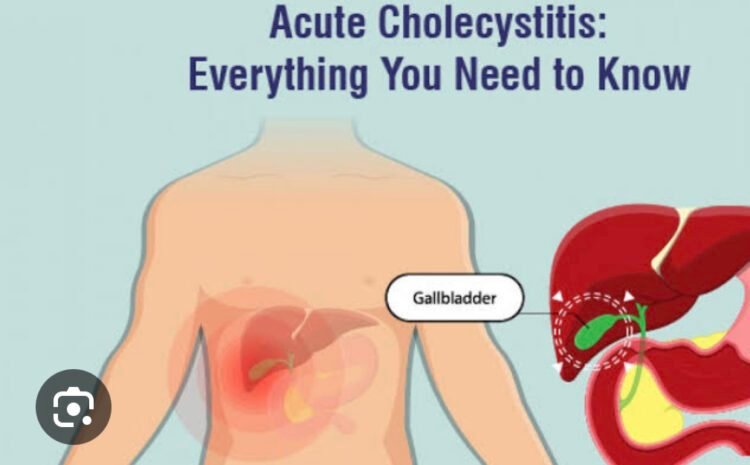Acute Calculus Cholecystitis