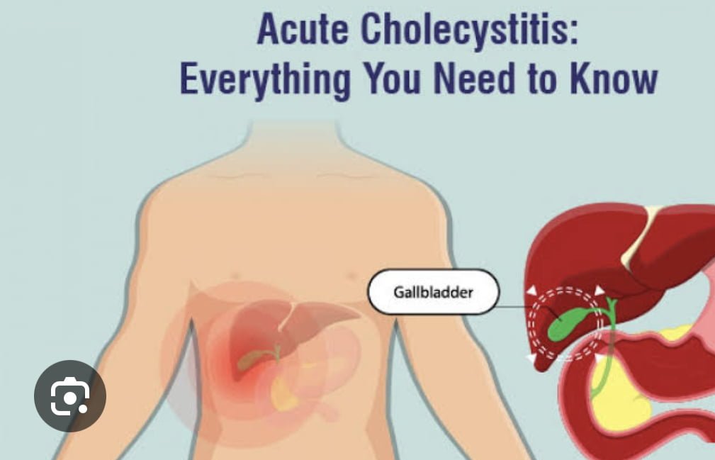 Acute Calculus Cholecystitis