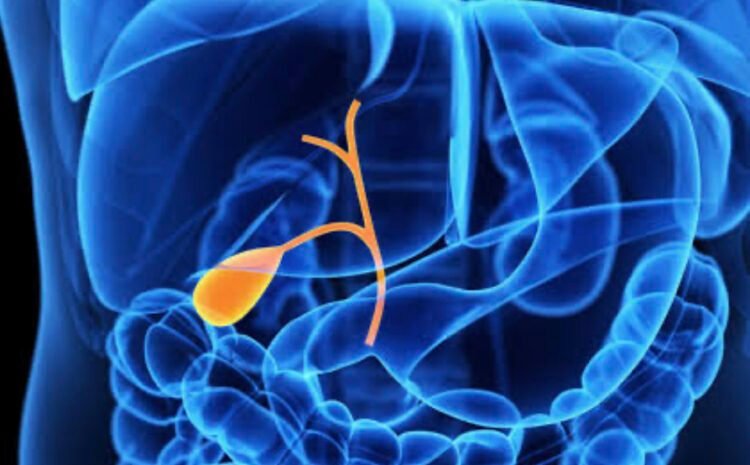 Complications of Untreated Gallbladder Stones
