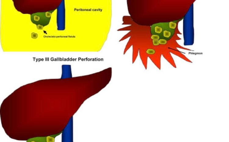 Gallbladder Perforation: Causes, Treatment, and Prevention