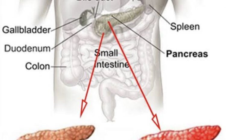 Acute Pancreatitis Causes Symptoms Diagnosis