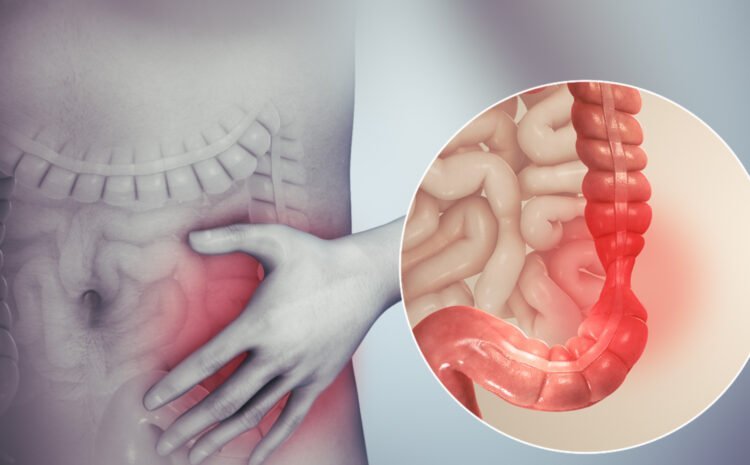 Irritable Bowel Syndrome (IBS) and Constipation