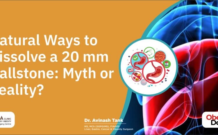 Natural Ways to Dissolve a 20 mm Gallstone: Myth or Reality?