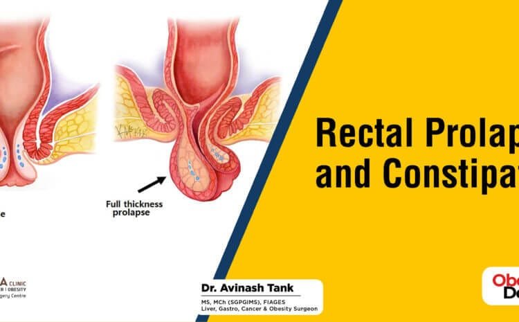 Rectal Prolapse and Constipation