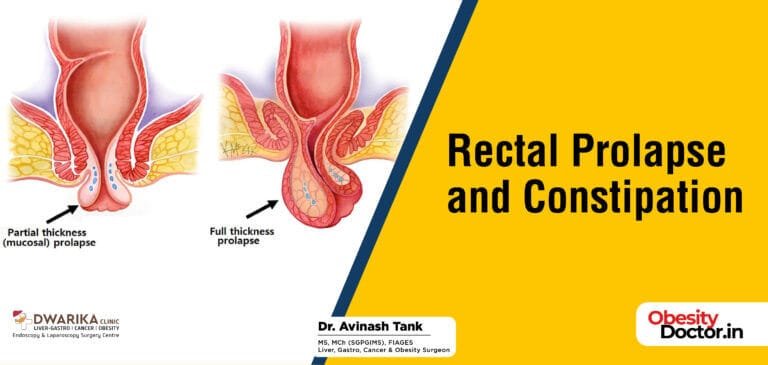 Rectal Prolapse and Constipation - Dr AvinashTank, is a super ...