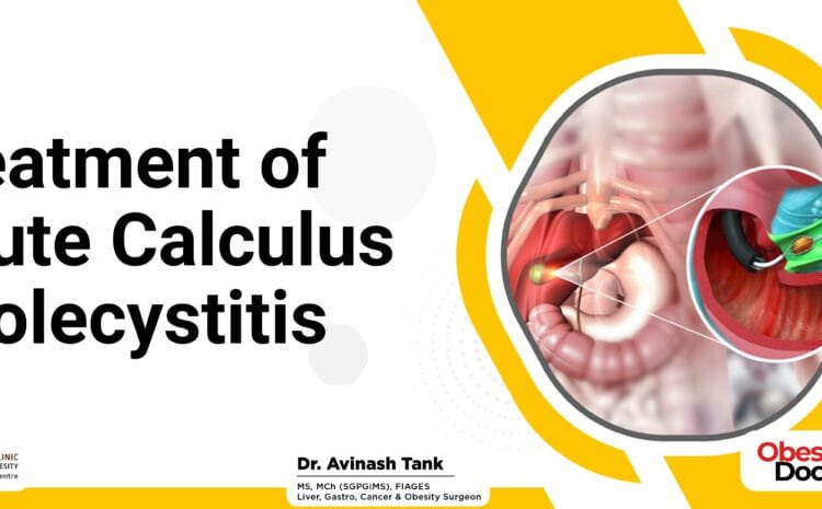Treatment of Acute Calculus Cholecystitis