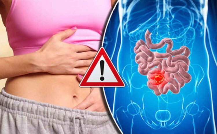 Fecal Impaction Causes and Treatment