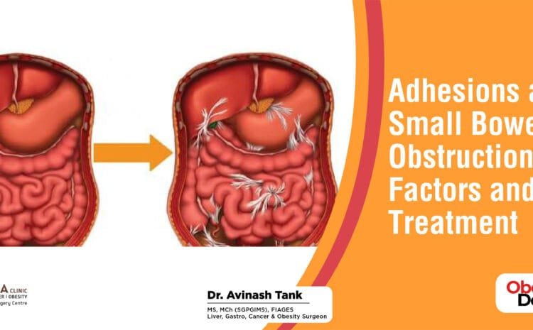 Adhesions and Small Bowel Obstruction:Risk Factors and Treatment