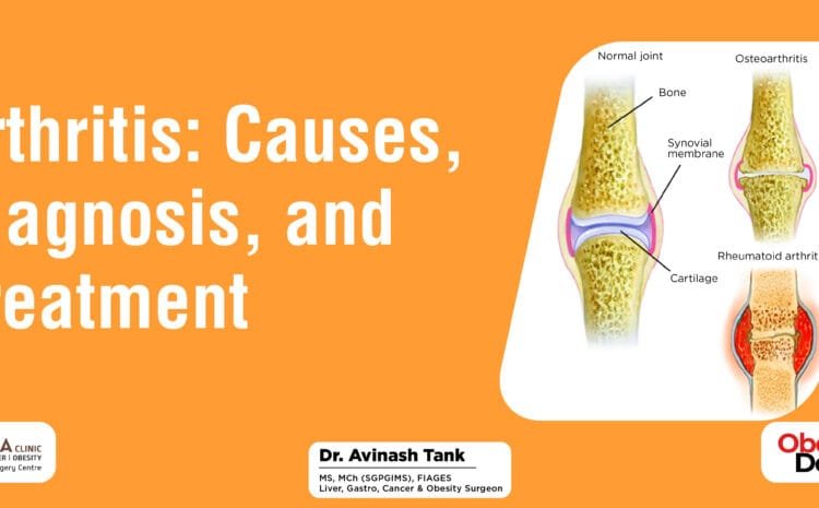 Arthritis Causes Diagnosis, and Treatment