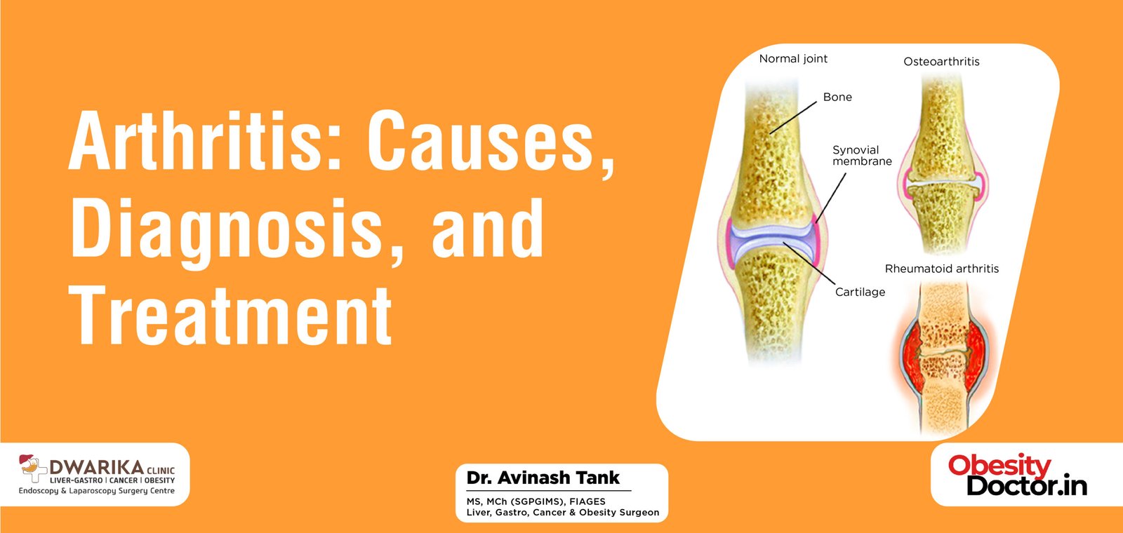 Arthritis: Causes, Diagnosis, and Treatment - Dr AvinashTank, is a ...