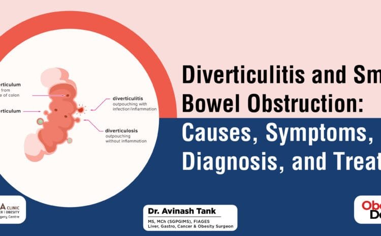 Diverticulitis and Small Bowel Obstruction: Causes, Symptoms, Diagnosis, and Treatment