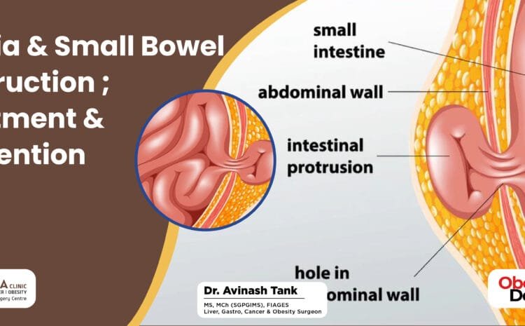 Hernia & Small Bowel Obstruction; Treatment & Prevention.