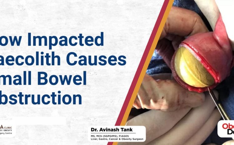 How Impacted Faecolith Causes Small Bowel Obstruction