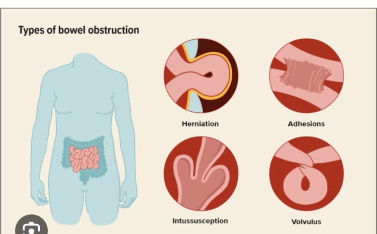 Small Bowel Obstruction: Causes, Symptoms & Treatment.