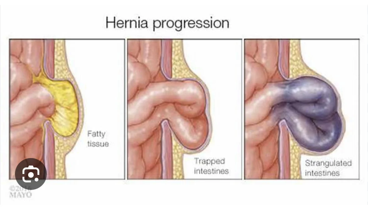 Femoral Hernia Repair - Surgery Rapid Review Notes Dr.