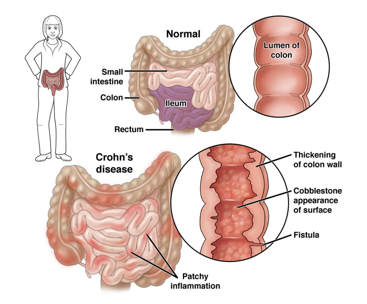 Female Bowel Obstruction: Symptoms and Treatment Options