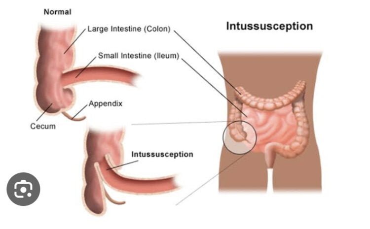 Intussusception and Small Bowel Obstruction