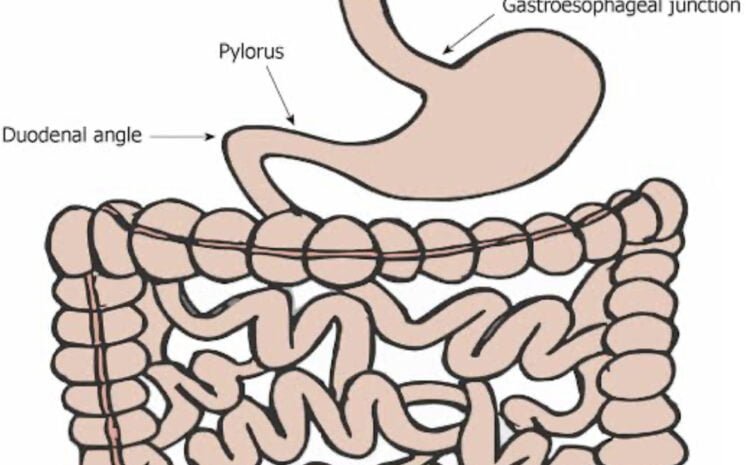 Foreign Bodies and Small Bowel Obstruction: Causes, Symptoms, and Treatment