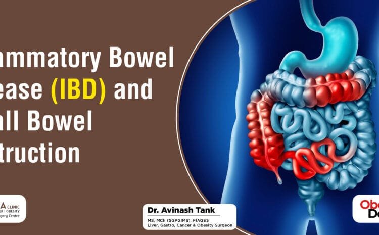 Inflammatory Bowel Disease (IBD) and Small Bowel Obstruction