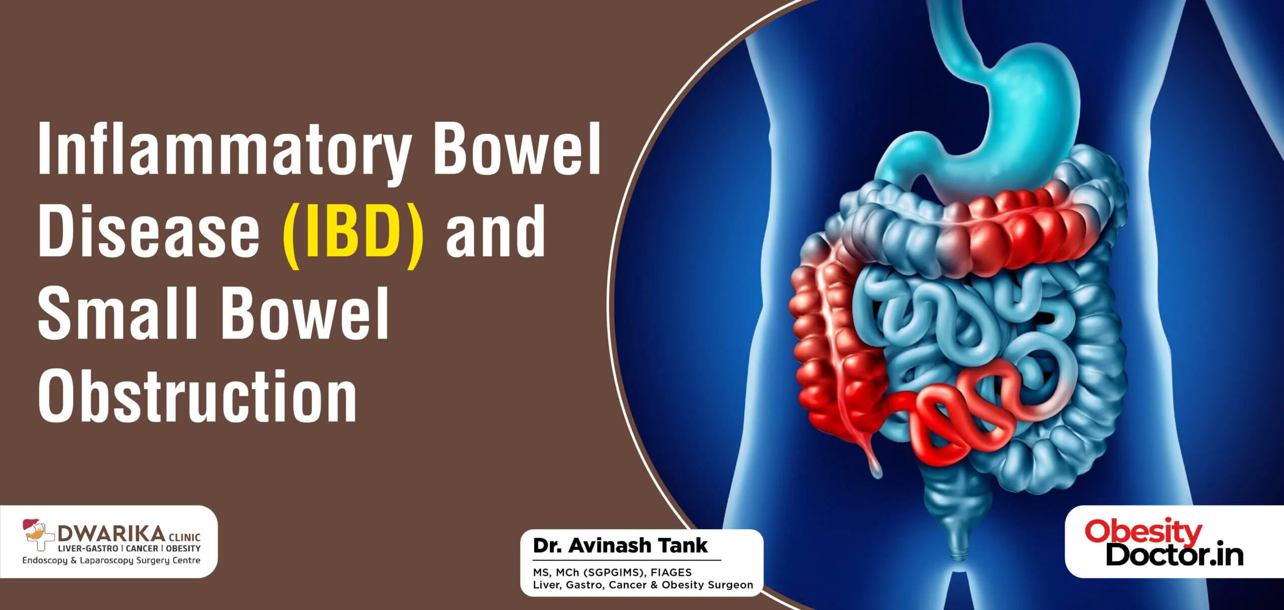 Inflammatory Bowel Disease (IBD) and Small Bowel Obstruction - Dr  AvinashTank, is a super-specialist (MCh) Laparoscopic Gastro-intestinal  Surgeon,