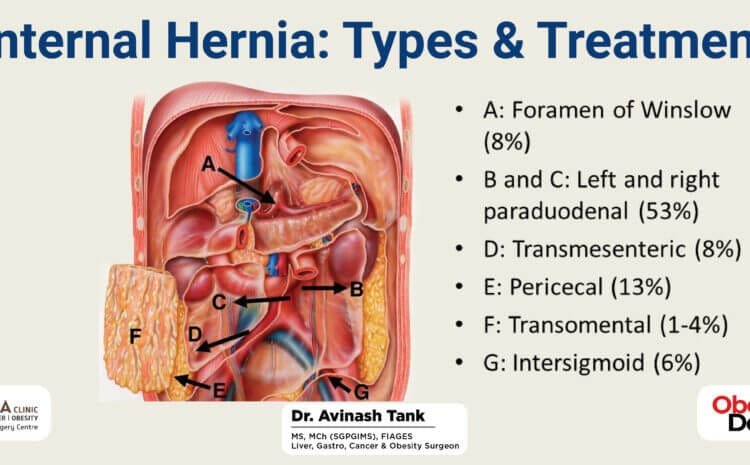 Internal Hernia: Types & Treatment.