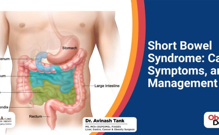 Short Bowel Syndrome: Causes, Symptoms, and Management