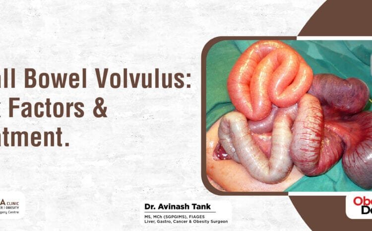 Small Bowel Volvulus: Risk Factors & Treatment.