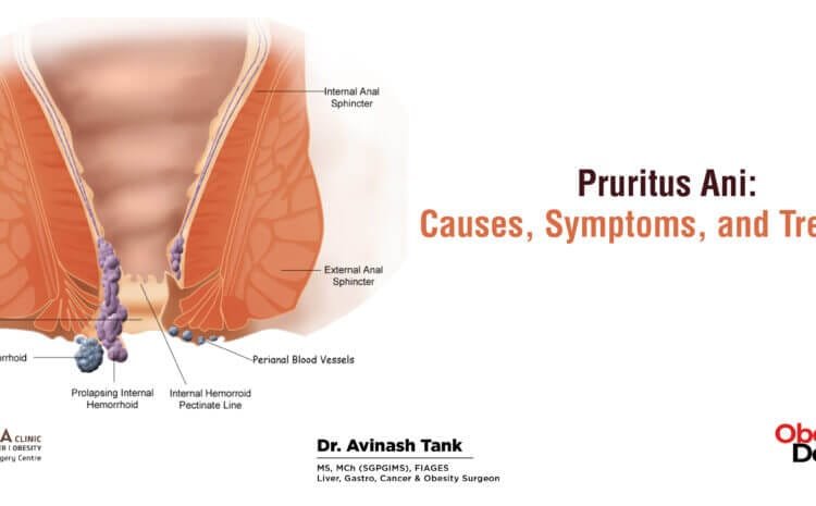 Pruritus Ani: Causes, Symptoms, and Treatment