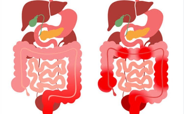 Malnutrition Risk in IBD Patients: Simple Screening Tool Offers Early Intervention